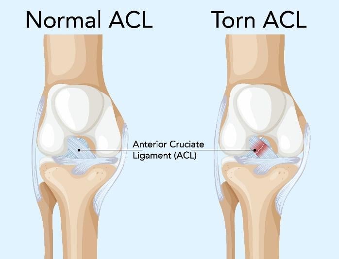 acl diagram