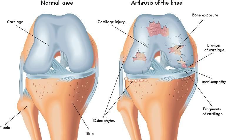 Knee Osteoarthritis Diagram