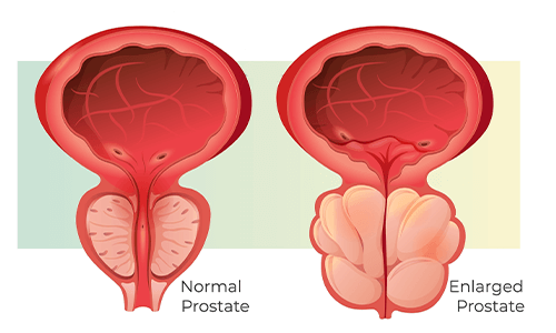 diagram normal and enlarged prostate