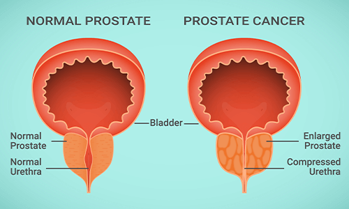 diagram of prostate glands