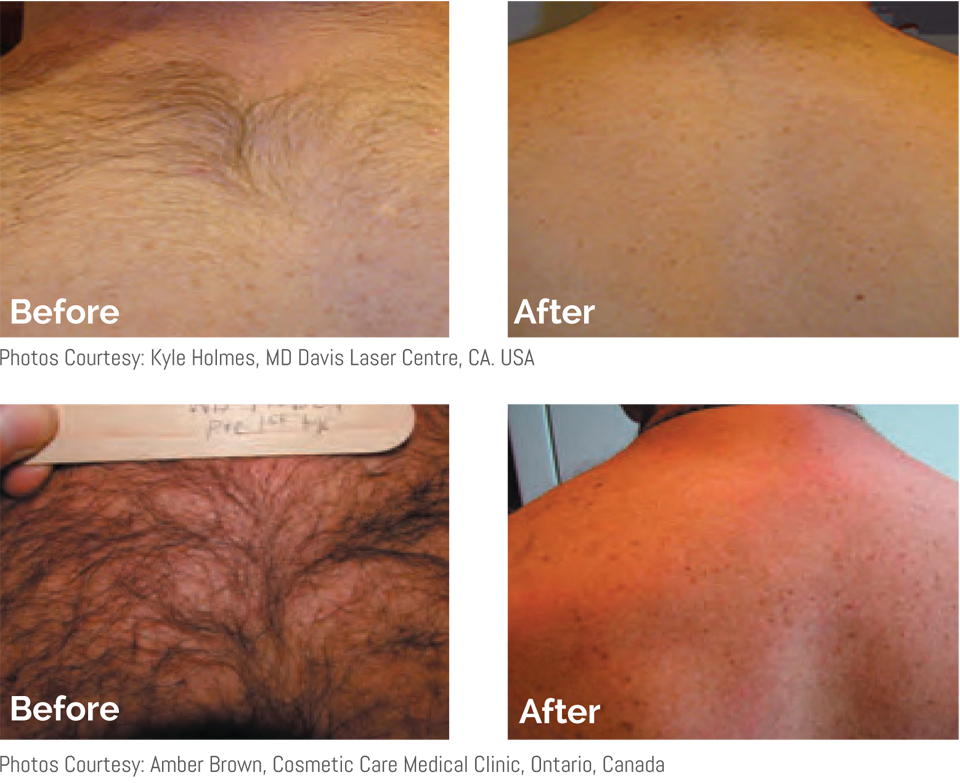 Back, shoulders, full arms Laser Hair Removal For Men