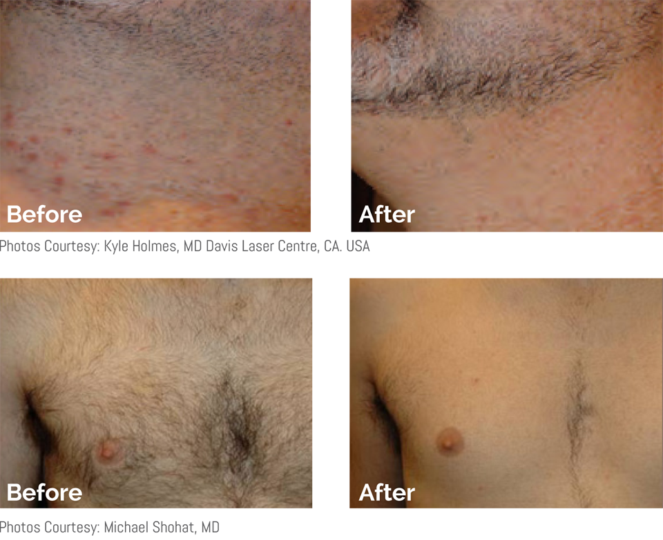 Beard laser deals hair removal