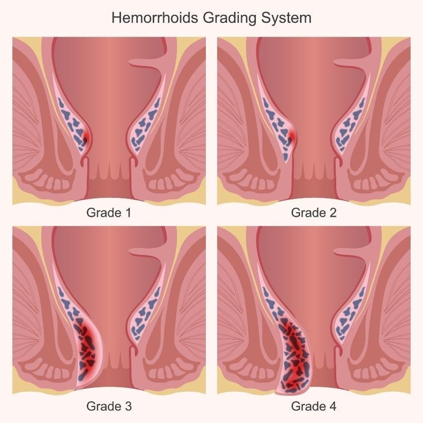 Hemorrhoids Grading System diagram